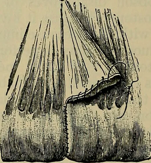 An illustration from Modern surgery, general and operative / by John Chalmers DaCosta., 1914, leaf 1136