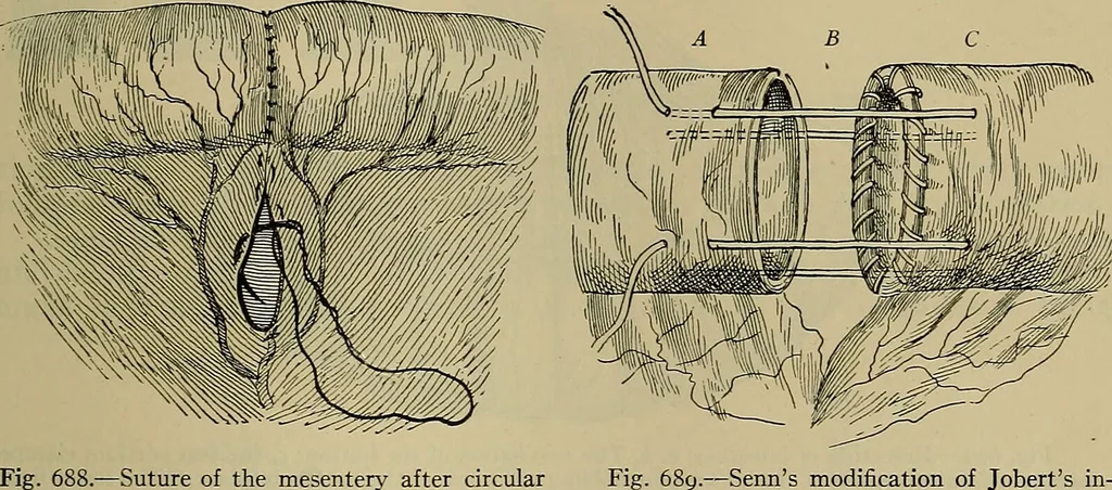 An illustration from Modern surgery, general and operative / by John Chalmers DaCosta., 1914, leaf 1137