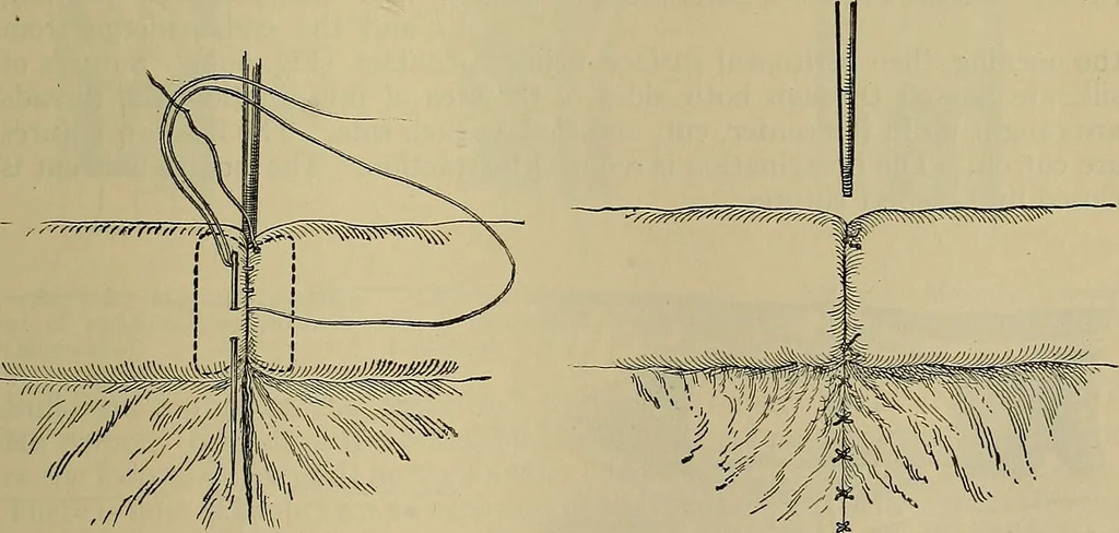 An illustration from Modern surgery, general and operative / by John Chalmers DaCosta., 1914, leaf 1139