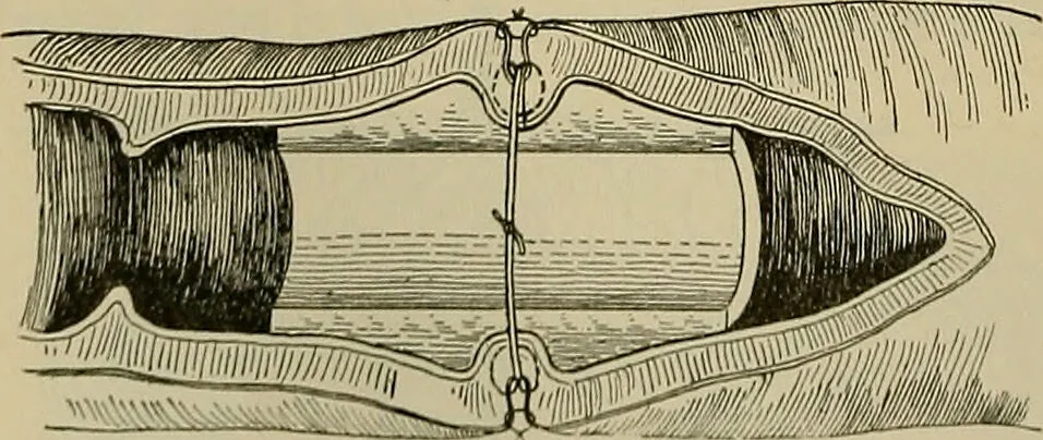 An illustration from Modern surgery, general and operative / by John Chalmers DaCosta., 1914, leaf 1140