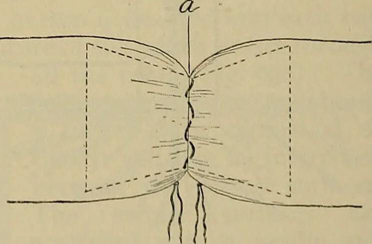 An illustration from Modern surgery, general and operative / by John Chalmers DaCosta., 1914, leaf 1140