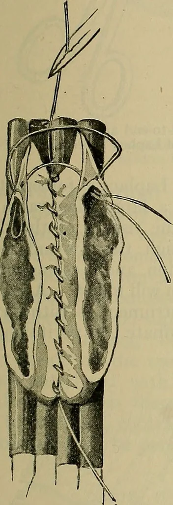 An illustration from Modern surgery, general and operative / by John Chalmers DaCosta., 1914, leaf 1141