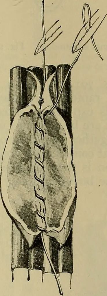 An illustration from Modern surgery, general and operative / by John Chalmers DaCosta., 1914, leaf 1141