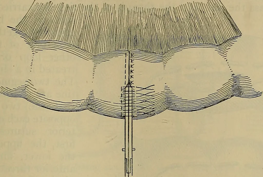 An illustration from Modern surgery, general and operative / by John Chalmers DaCosta., 1914, leaf 1143