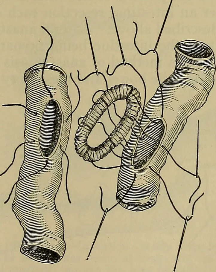 An illustration from Modern surgery, general and operative / by John Chalmers DaCosta., 1914, leaf 1143