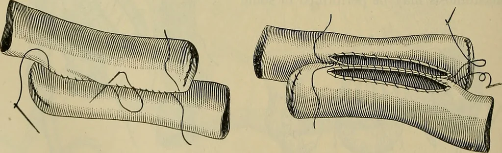 An illustration from Modern surgery, general and operative / by John Chalmers DaCosta., 1914, leaf 1144