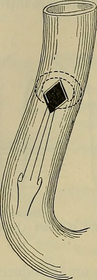 An illustration from Modern surgery, general and operative / by John Chalmers DaCosta., 1914, leaf 1146