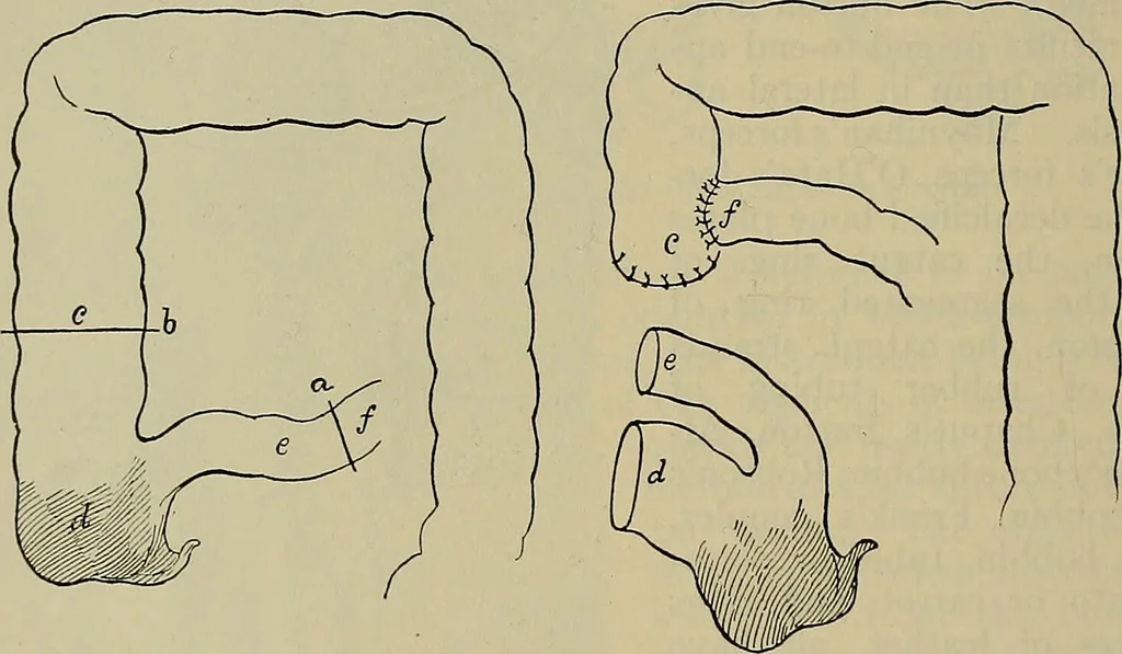 An illustration from Modern surgery, general and operative / by John Chalmers DaCosta., 1914, leaf 1148