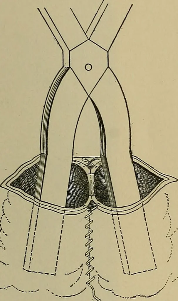 An illustration from Modern surgery, general and operative / by John Chalmers DaCosta., 1914, leaf 1153