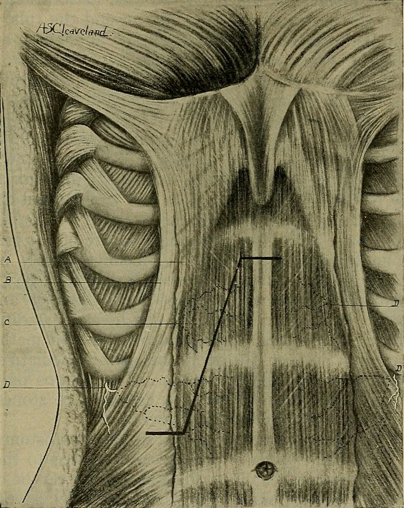 An illustration from Modern surgery, general and operative / by John Chalmers DaCosta., 1914, leaf 1155