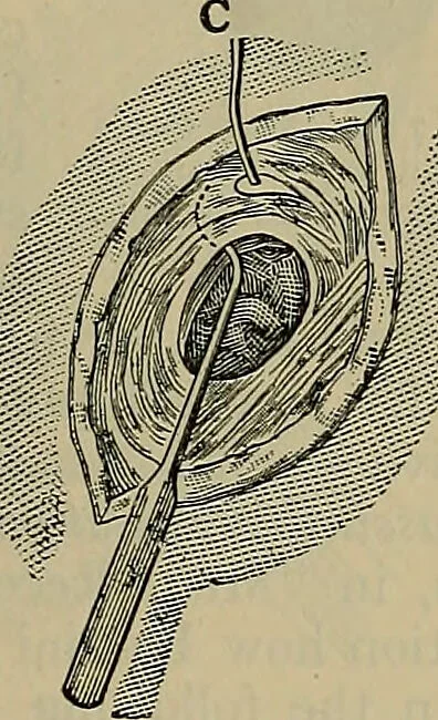 An illustration from Modern surgery, general and operative / by John Chalmers DaCosta., 1914, leaf 1185