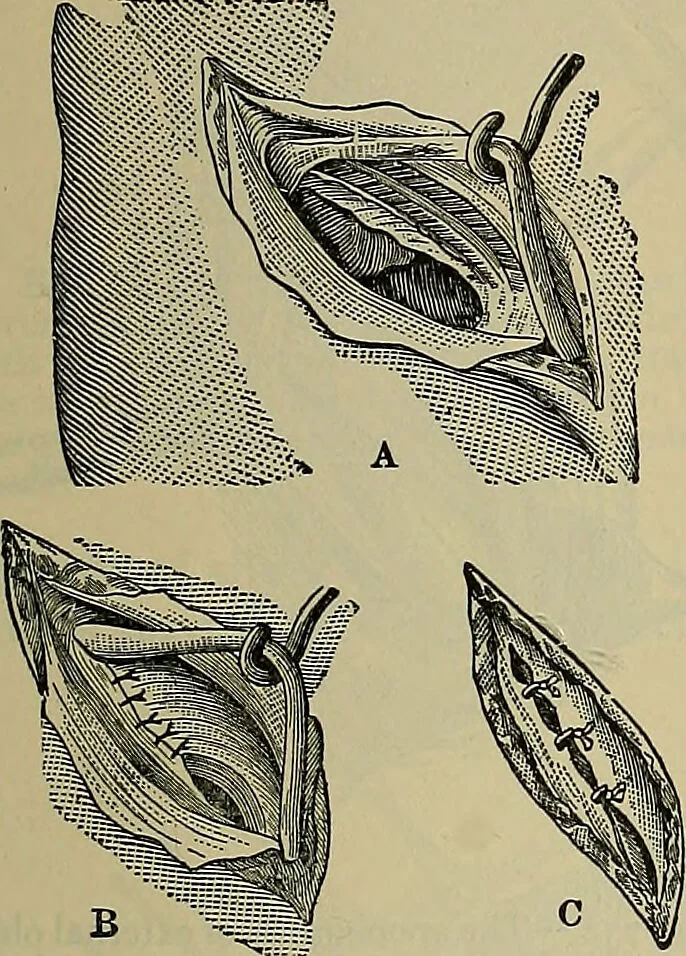 An illustration from Modern surgery, general and operative / by John Chalmers DaCosta., 1914, leaf 1187