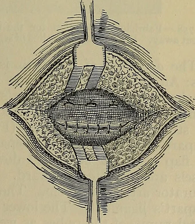 An illustration from Modern surgery, general and operative / by John Chalmers DaCosta., 1914, leaf 1195