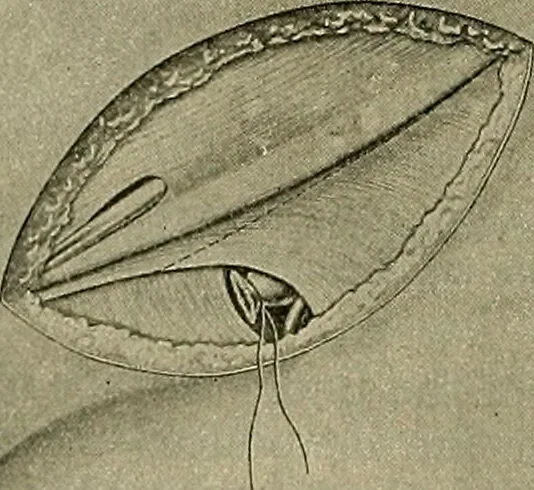 An illustration from Modern surgery, general and operative / by John Chalmers DaCosta., 1914, leaf 1196