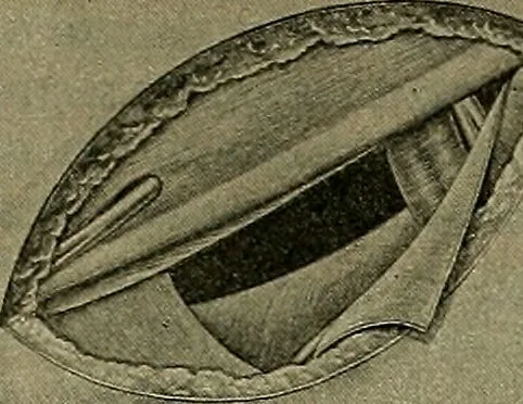An illustration from Modern surgery, general and operative / by John Chalmers DaCosta., 1914, leaf 1197