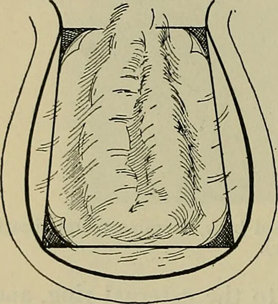 An illustration from Modern surgery, general and operative / by John Chalmers DaCosta., 1914, leaf 1198