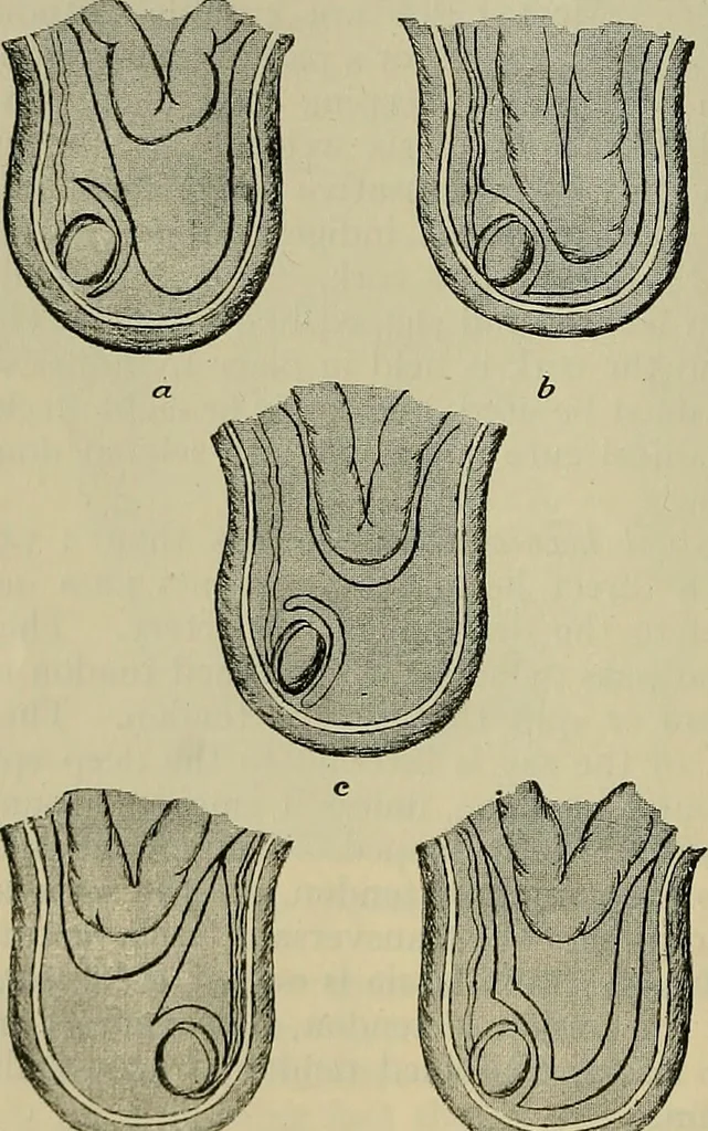 An illustration from Modern surgery, general and operative / by John Chalmers DaCosta., 1914, leaf 1206