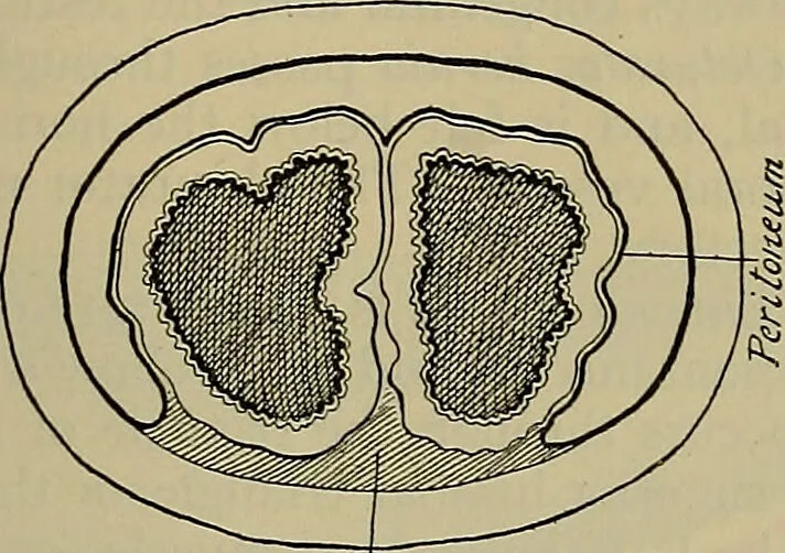 An illustration from Modern surgery, general and operative / by John Chalmers DaCosta., 1914, leaf 1207