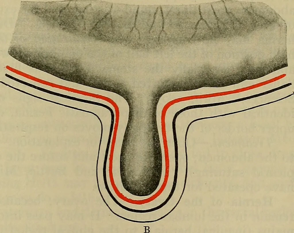 An illustration from Modern surgery, general and operative / by John Chalmers DaCosta., 1914, leaf 1209