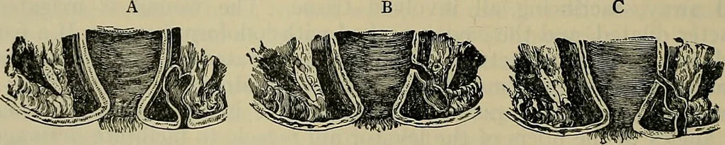 An illustration from Modern surgery, general and operative / by John Chalmers DaCosta., 1914, leaf 1220