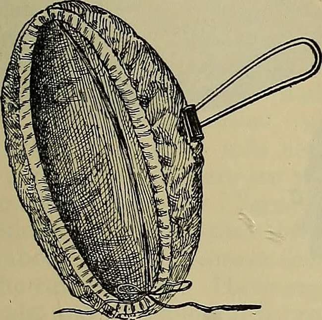 An illustration from Modern surgery, general and operative / by John Chalmers DaCosta., 1914, leaf 1243