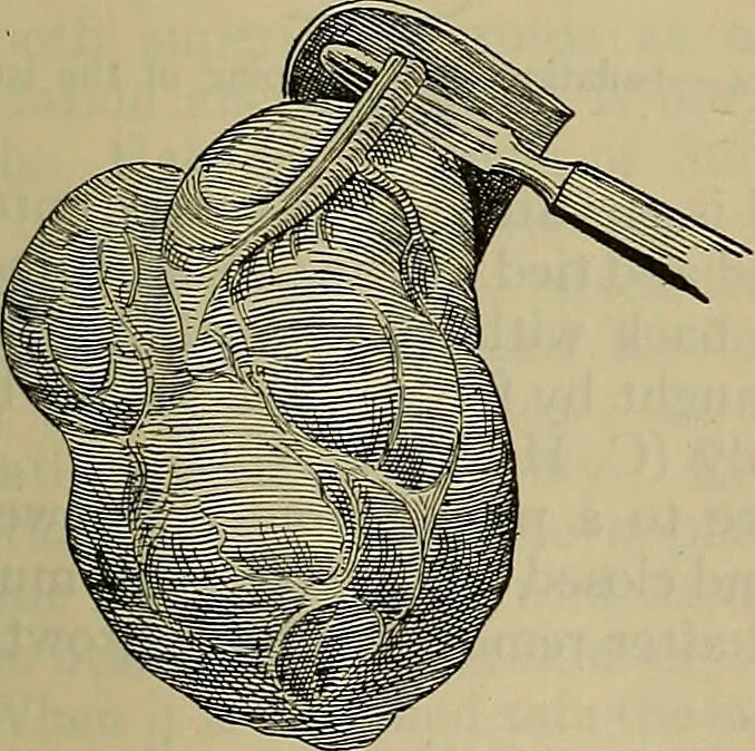 An illustration from Modern surgery, general and operative / by John Chalmers DaCosta., 1914, leaf 1287