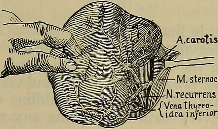 An illustration from Modern surgery, general and operative / by John Chalmers DaCosta., 1914, leaf 1287