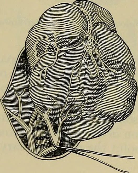 An illustration from Modern surgery, general and operative / by John Chalmers DaCosta., 1914, leaf 1288