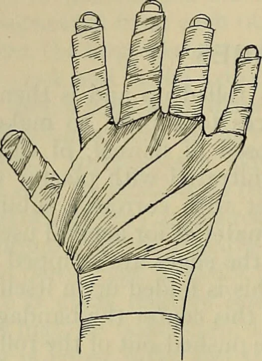 An illustration from Modern surgery, general and operative / by John Chalmers DaCosta., 1914, leaf 1300