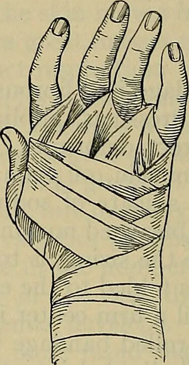 An illustration from Modern surgery, general and operative / by John Chalmers DaCosta., 1914, leaf 1300