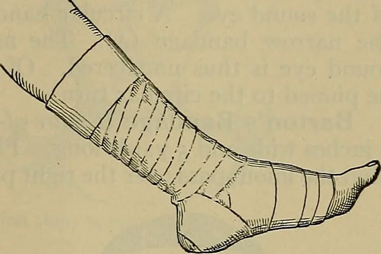 An illustration from Modern surgery, general and operative / by John Chalmers DaCosta., 1914, leaf 1301