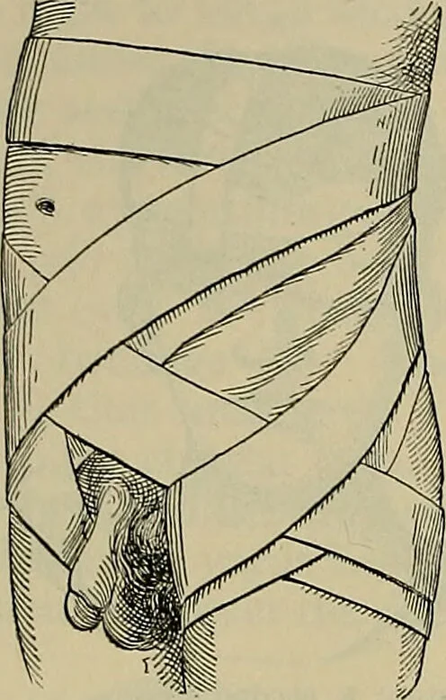 An illustration from Modern surgery, general and operative / by John Chalmers DaCosta., 1914, leaf 1304