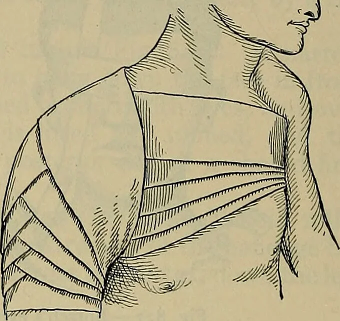 An illustration from Modern surgery, general and operative / by John Chalmers DaCosta., 1914, leaf 1304