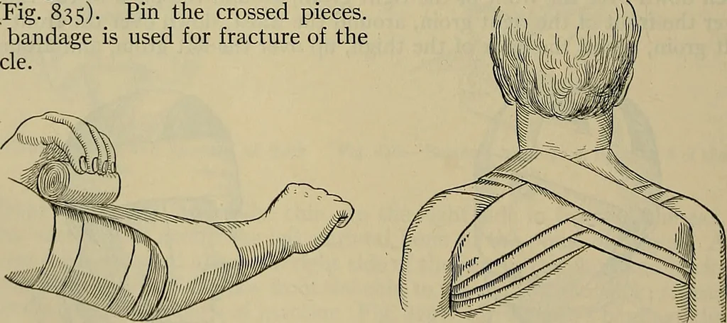 An illustration from Modern surgery, general and operative / by John Chalmers DaCosta., 1914, leaf 1304