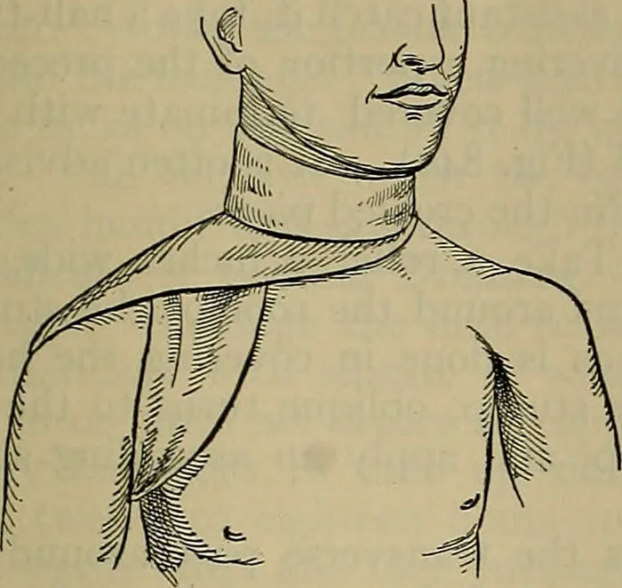 An illustration from Modern surgery, general and operative / by John Chalmers DaCosta., 1914, leaf 1305