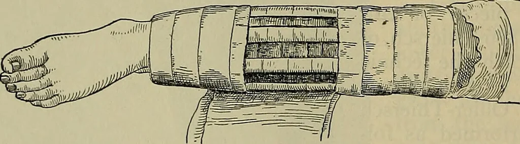 An illustration from Modern surgery, general and operative / by John Chalmers DaCosta., 1914, leaf 1310