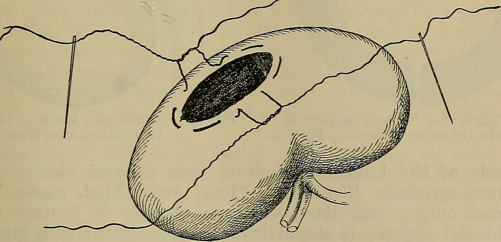 An illustration from Modern surgery, general and operative / by John Chalmers DaCosta., 1914, leaf 1327