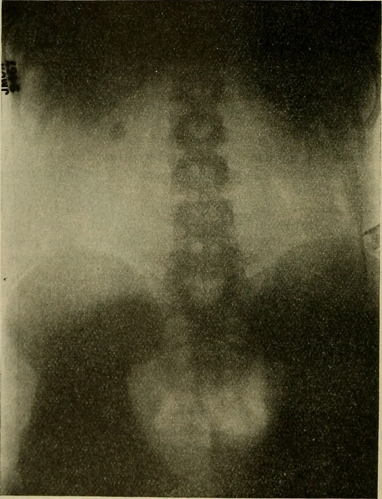 An illustration from Modern surgery, general and operative / by John Chalmers DaCosta., 1914, leaf 1330