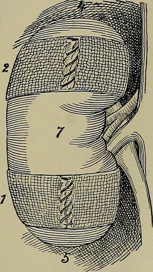 An illustration from Modern surgery, general and operative / by John Chalmers DaCosta., 1914, leaf 1343