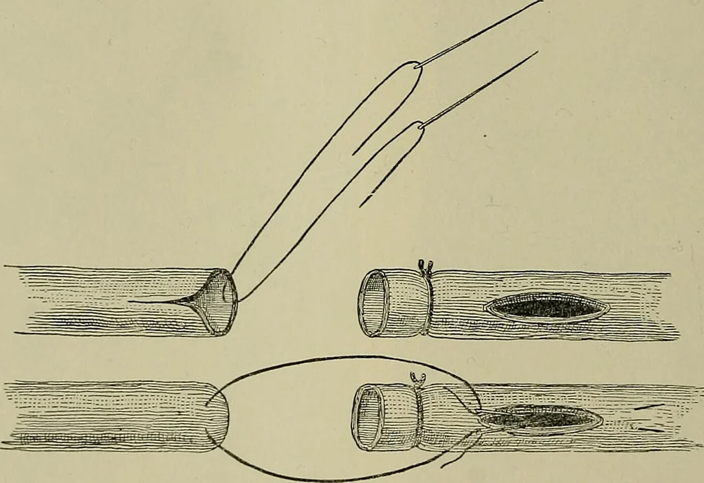 An illustration from Modern surgery, general and operative / by John Chalmers DaCosta., 1914, leaf 1346