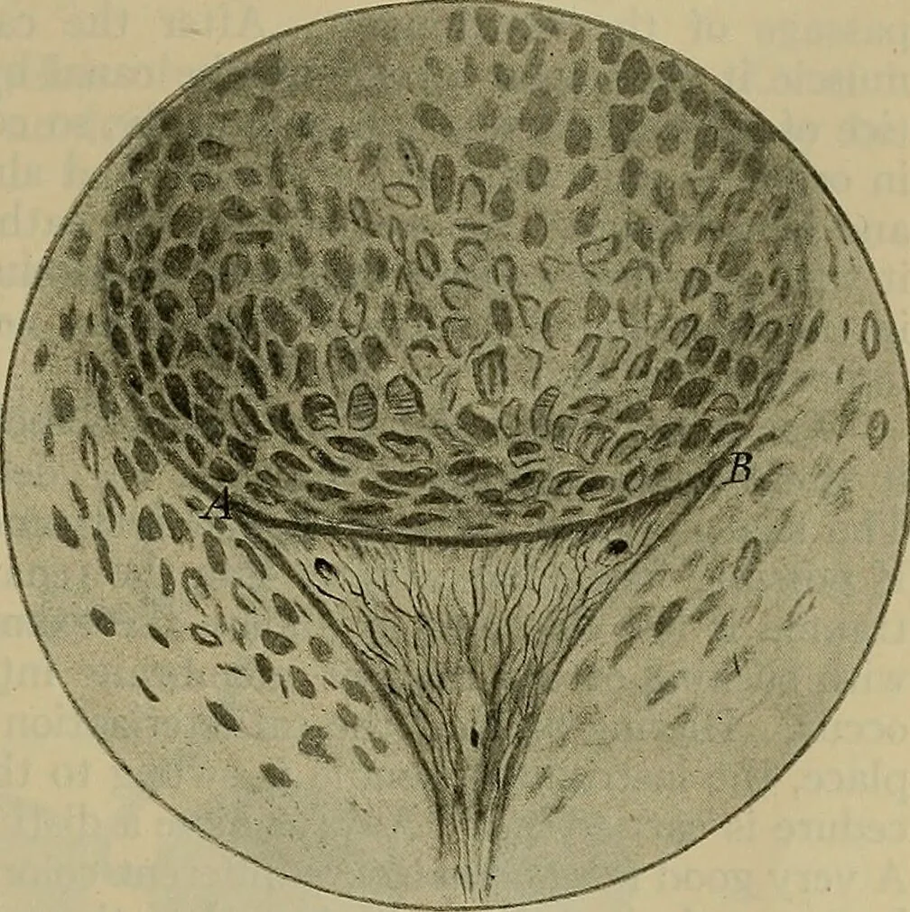 An illustration from Modern surgery, general and operative / by John Chalmers DaCosta., 1914, leaf 1351