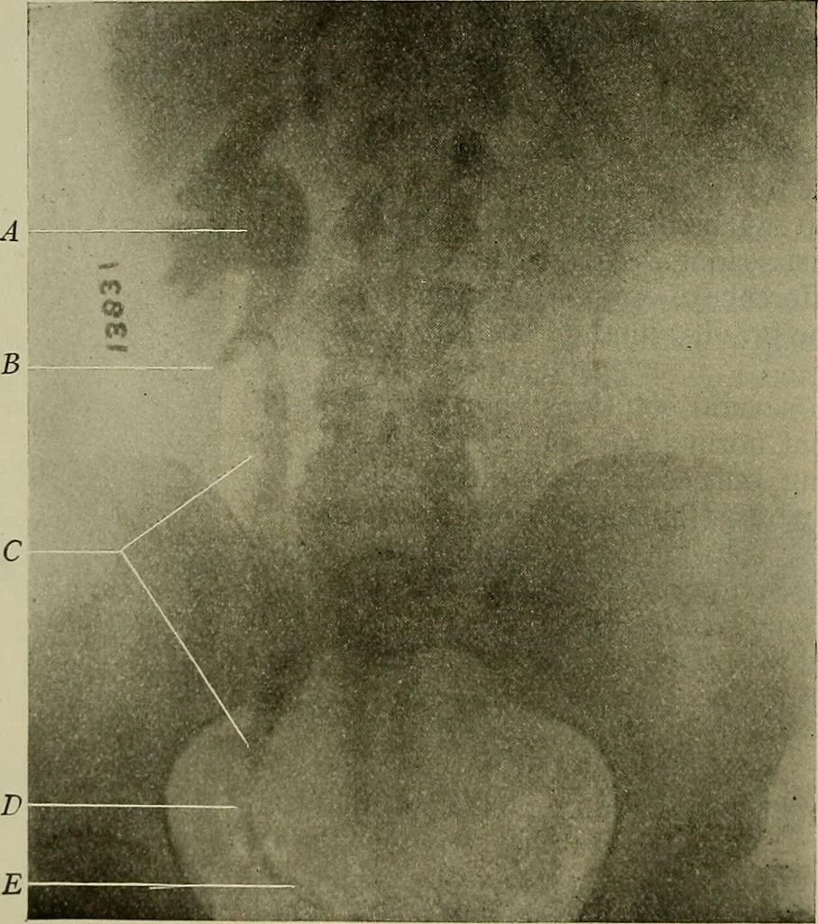 An illustration from Modern surgery, general and operative / by John Chalmers DaCosta., 1914, leaf 1356