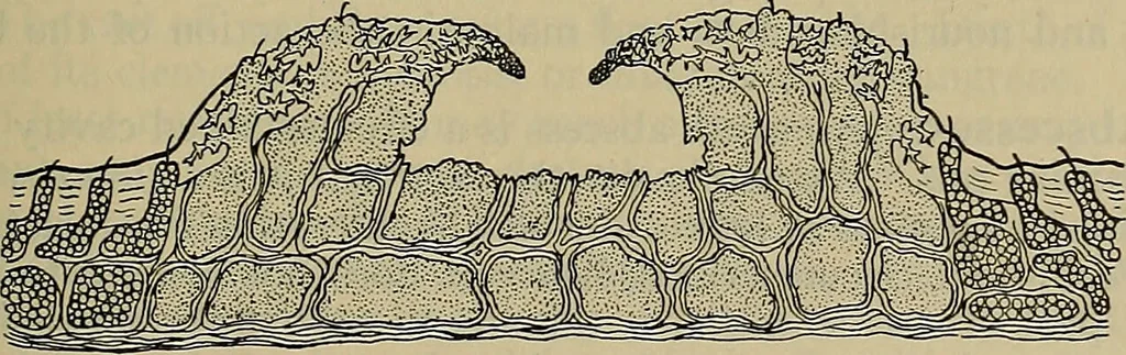 An illustration from Modern surgery, general and operative / by John Chalmers DaCosta., 1914, leaf 141