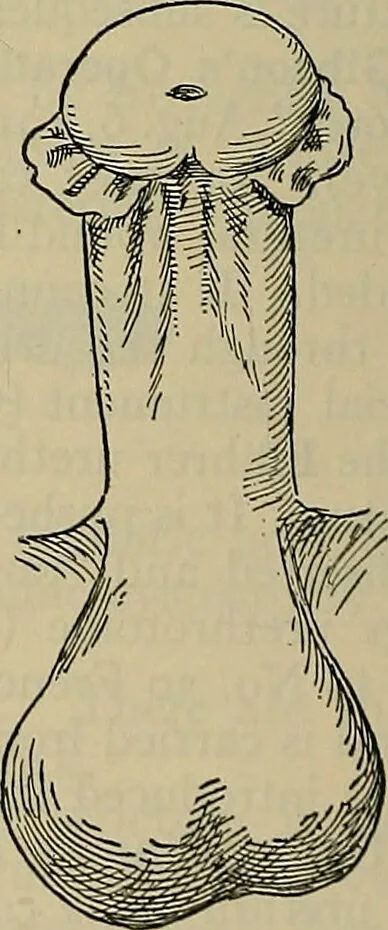 An illustration from Modern surgery, general and operative / by John Chalmers DaCosta., 1914, leaf 1418