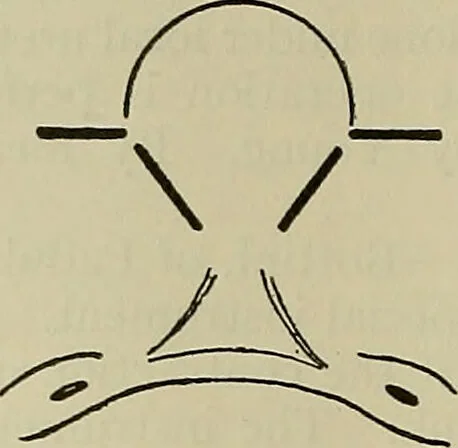 An illustration from Modern surgery, general and operative / by John Chalmers DaCosta., 1914, leaf 1434