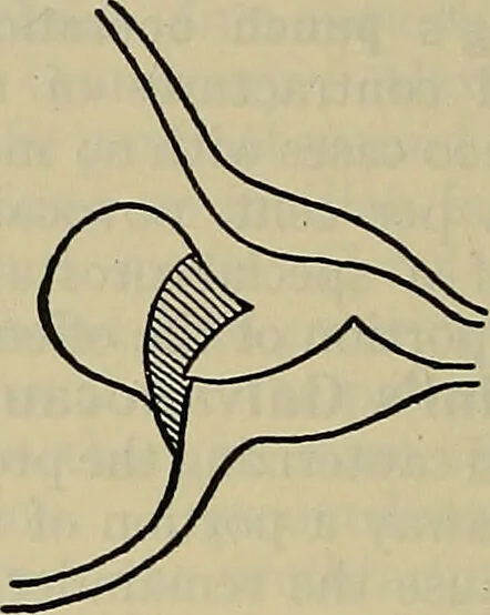 An illustration from Modern surgery, general and operative / by John Chalmers DaCosta., 1914, leaf 1434