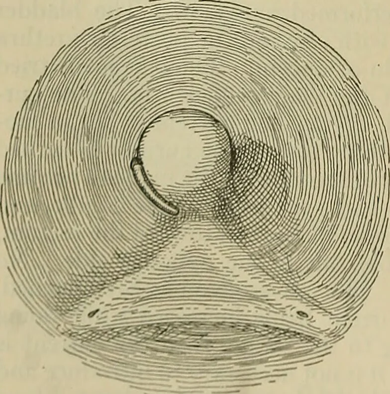 An illustration from Modern surgery, general and operative / by John Chalmers DaCosta., 1914, leaf 1434