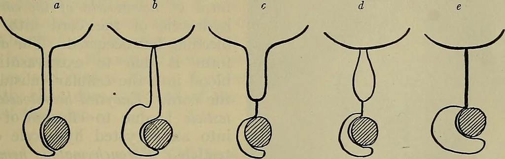 An illustration from Modern surgery, general and operative / by John Chalmers DaCosta., 1914, leaf 1445