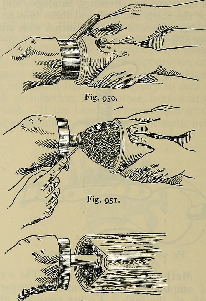 An illustration from Modern surgery, general and operative / by John Chalmers DaCosta., 1914, leaf 1450