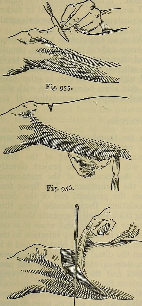 An illustration from Modern surgery, general and operative / by John Chalmers DaCosta., 1914, leaf 1451